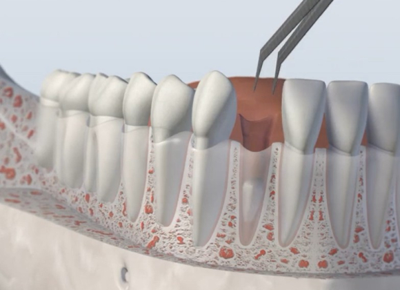 Third Coast OMS Socket Preservation